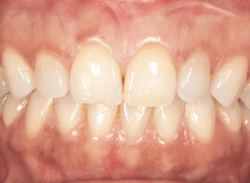 internal bleaching before