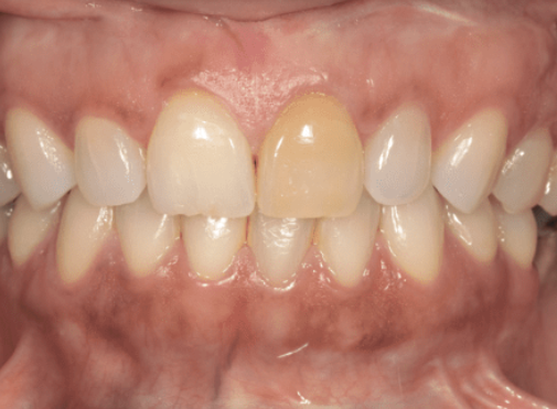 internal bleaching before