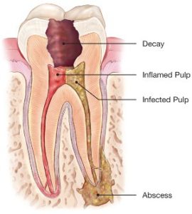 endodontics diagram